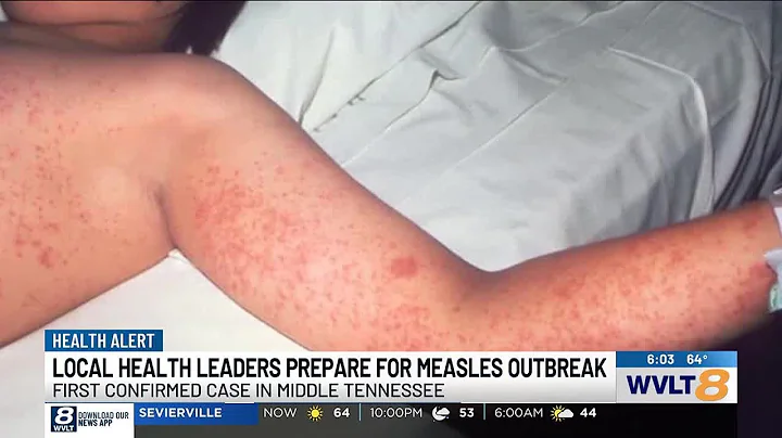 Health experts prepare for potential measles outbreak after first confirmed case in Tennessee