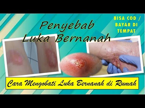 Penyebab dan Cara Mengobati Luka Bernanah di Rumah