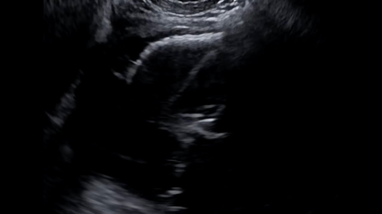 EUS-GUIDED GALLBLADDER DRAINAGE - FLORIDA LIVE EUS EDUCATIONAL VIDEO ...