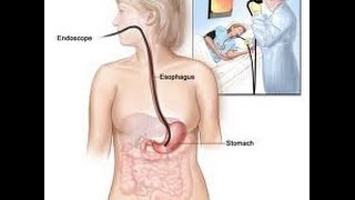 What is an Upper Endoscopy? | Los Angeles Endoscopy