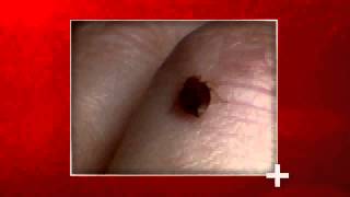Bed bug bites vs flea bites