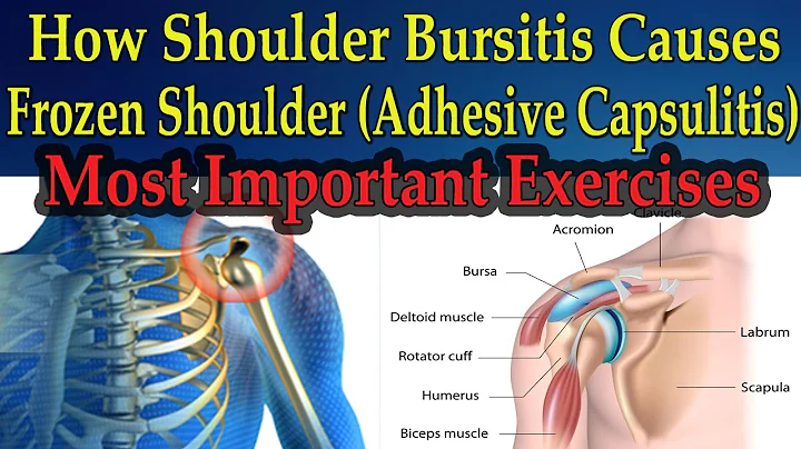 How Shoulder Bursitis Causes Frozen Shoulder (MOST IMPORTANT EXERCISES) - Dr Mandell