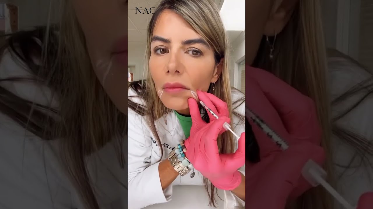Injection For Downturned Mouth Botox Antiaging Beauty Fillers Fillersinjection