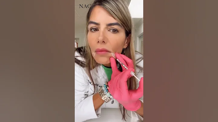 Injection for Downturned Mouth #botox #antiaging #beauty #fillers #fillersinjection