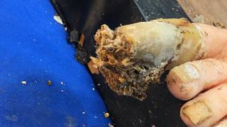 Ingrown toenails with onychomycosis, toenails have fungus black mud 1585