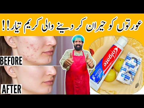 How To Remove Pimples Overnight | Acne Treatment | Remove Dark Spots |100% Effective | BaBa Food RRC