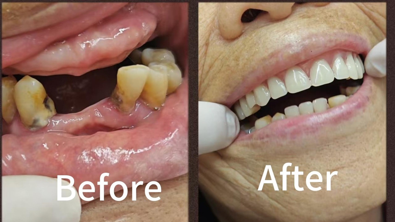 Satisfying False Teeth#SatisfyingProcess#Dentist