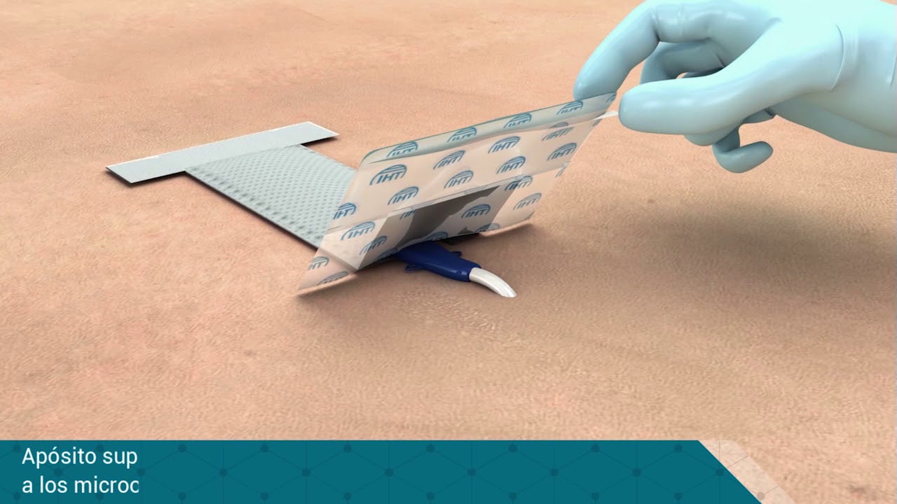 Oper Cat: funda protectora con apósito para catéteres venosos centrales ...