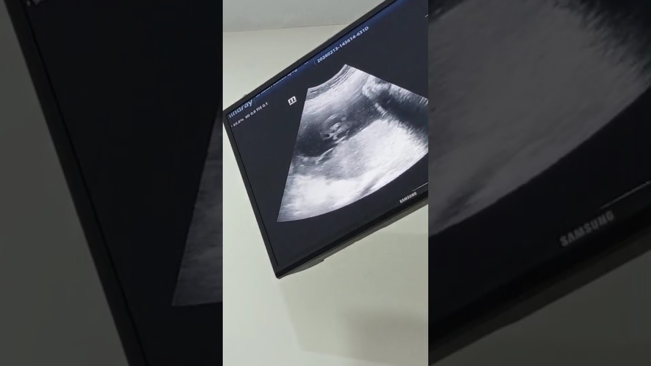 Anaknya Mala dan Abdulkodir  8 bulan 