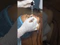 Facial peeling therapy 😇🥰