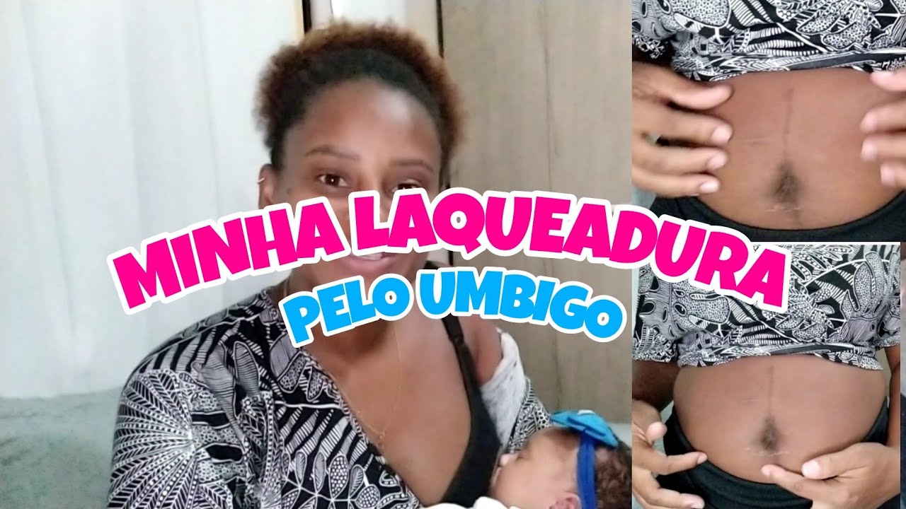 FIZ LAQUEADURA PELO UMBIGO PÓS PARTO NORMAL PELO SUS. - YouTube
