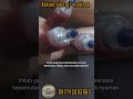KESERINGAN KESEMUTAN &amp; KEBAS? Jangan Dianggap Sepele! Alhamdulillah Sembuh Total Setelah Bekam