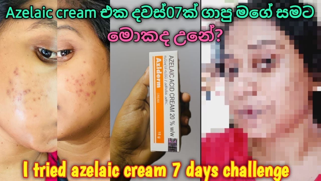 AZELAIC Cream දවස් 07ක Challenge එක | දවස් 07කට පස්සේ මගේ මුනට මොකද උනේ? #azelaicacidcream #skincare