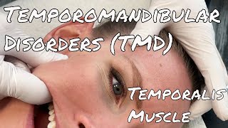 TMJ Pain - Temporalis Release - Motion Specific Release