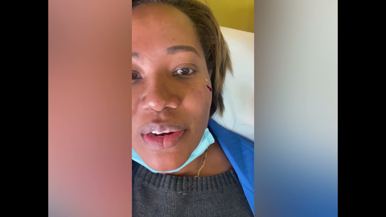 Choose threads over fillers for tear troughs