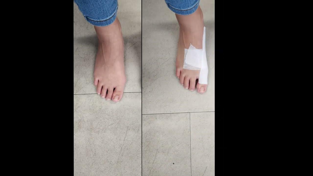 A Simple Technique For Taping Children With Bunions YouTube