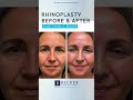 Rhinoplasty Results at 1 Month 👃💙 | Dr. Becker