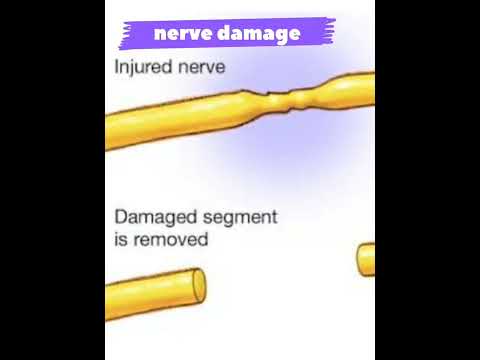 أسباب ضعف ونقص الكتله العضلية Muscle Atrophy