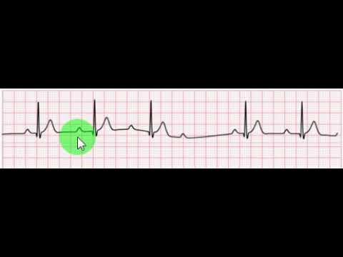 فيديو: كتلة القلب (موبيتز النوع الأول) في الكلاب