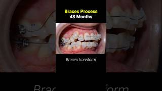 Braces In 48 Months