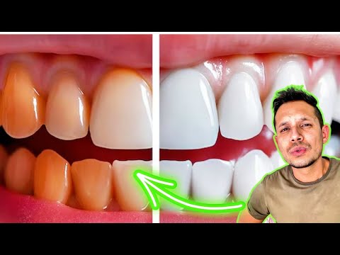 DIENTES AMARILLOS por
