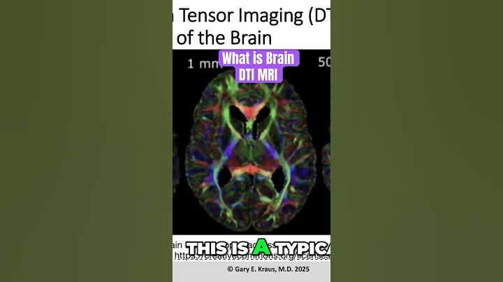 BRAIN DTI MRI Dr Kraus explains Traumatic Brain Injury #KrausTBI #braininjury #tbi #houston #shorts