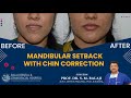 Mandibular setback with chin correction