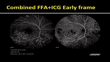 AIOC2018 - GP079 - Topic - Evaluation of Choroid by Optical Coherence Tomography