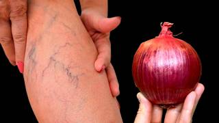 Just 2 products, and varicose veins disappear on their own! Incredible but true, completely without