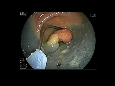 PEUTZ-JEGHERS SYNDROME: DBE AND SMALL BOWEL POLYPECTOMY