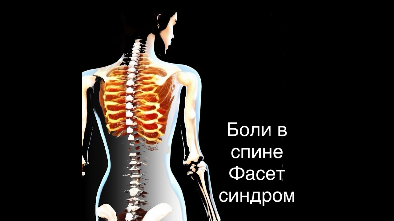 Боли в спине. Фасет синдром - YouTube
