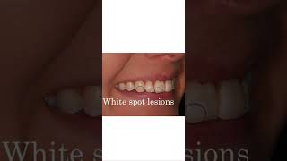 Get rid of white spots on your teeth ✨