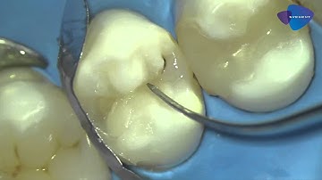 Class II restoration