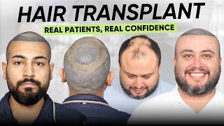 Hair Transplant in Chennai (HX-YFVD) | Best Results & Cost of Hair Transplant in Chennai