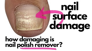 How Damaging Is Nail Polish Remover/Acetone?!  [Surprise, Surprise!] Net Worth