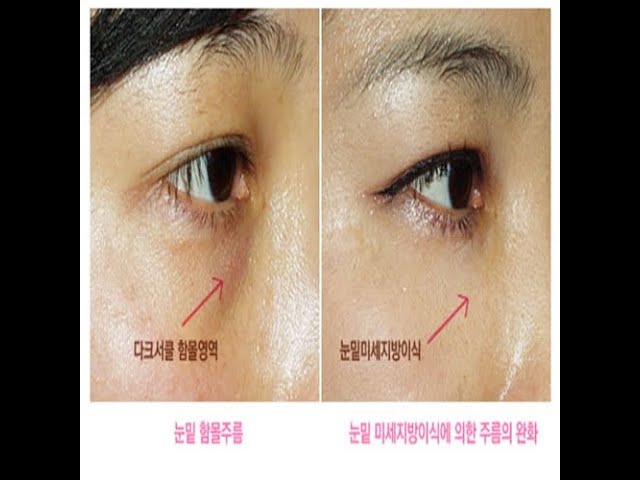 눈밑 지방이식은 지방주머니에만 지방이 주입되게 되면 울퉁불퉁 해지며 눈밑이 쳐저 보이는 단점이 있습니다.