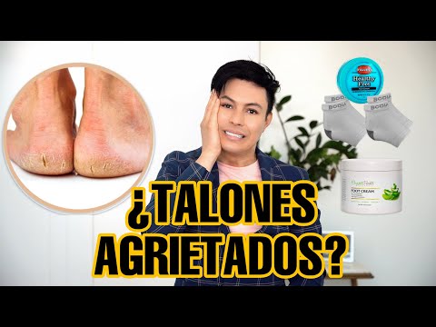 Video: Los mejores remedios para los talones agrietados