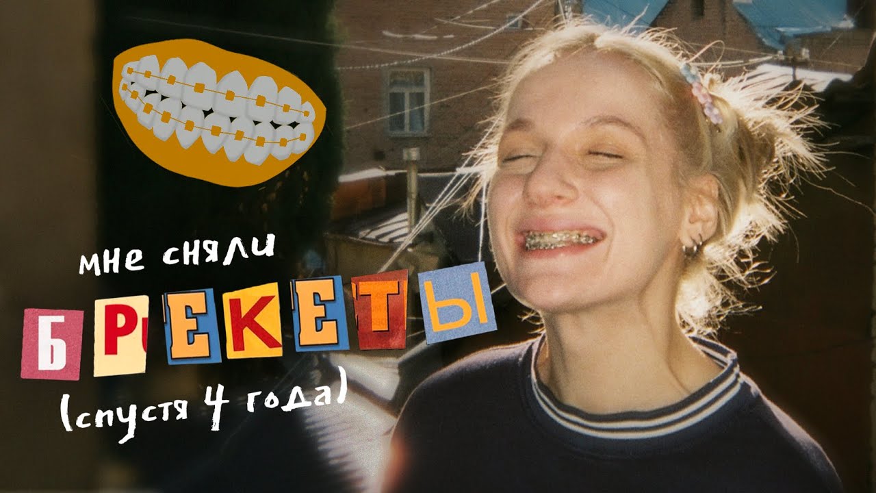 всё, что вам нужно знать о брекетах / ЦЕНА, БОЛЬ, ОГРАНИЧЕНИЯ и мой опыт