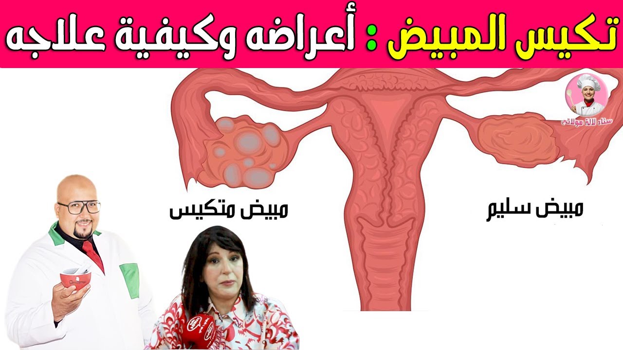 تكيس المبيض : أسبابه أعراضه وكيفية علاجه مع الدكتورة نادية امزيان والدكتور عماد ميزاب
