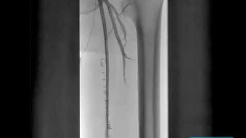 Proximal to Distal SFA CTO Treated with Viance