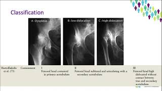 OrthoFracs  Adult Hip Dysplasia by Dr Karen Bourns