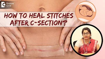 6 Tips to Take Care of Stitches & Heal Fast After C-Section -Dr.Supritha Rangaswamy| Doctors' Circle