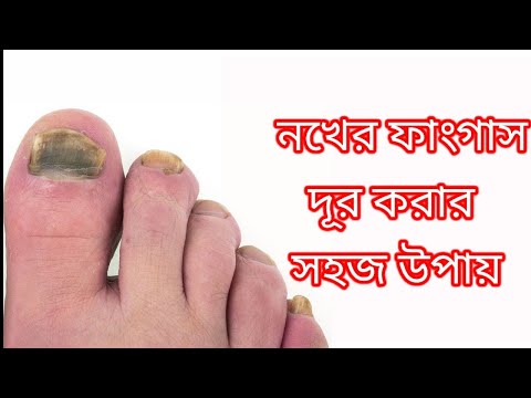 ভিডিও: নখের ছত্রাকের বিরুদ্ধে মাইকোডারিল