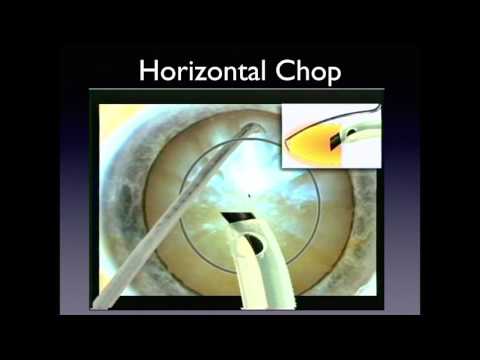 Video: Progressiv Cracking-teknikk For Phacoemulsification Av Superhard Grå Stær: En Saksrapport