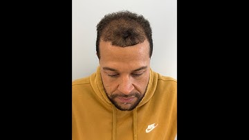 How to deal with hair thinning? Here’s the answer: New Look with SMP!!