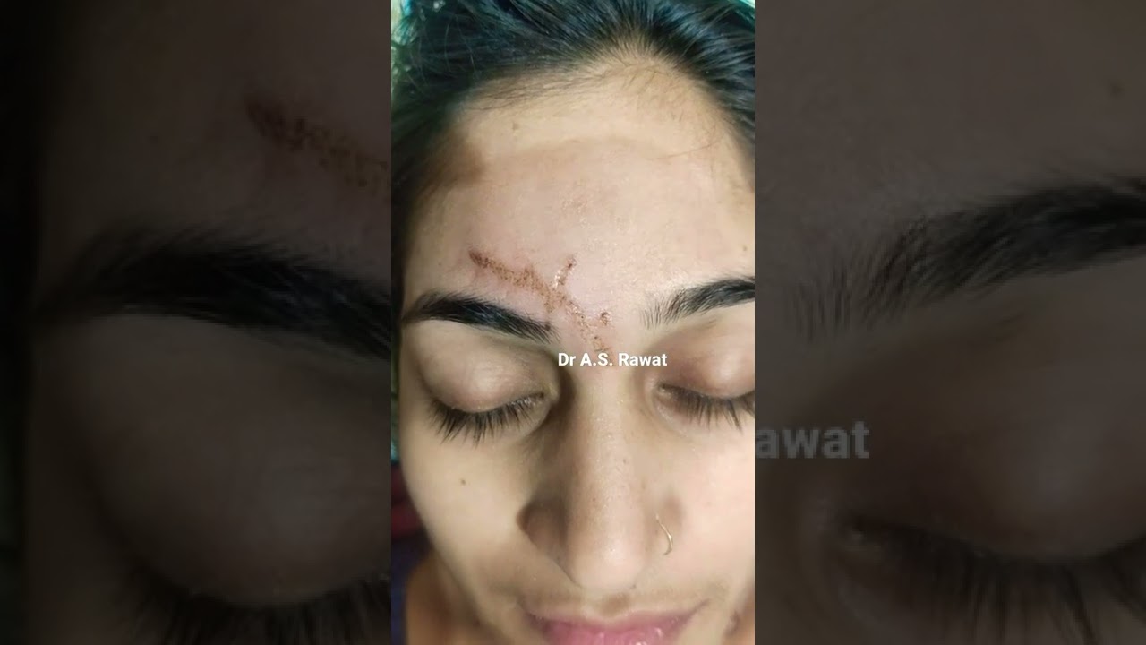 पुरानी चोट का निशान लेजर मशीन द्वारा हटाए