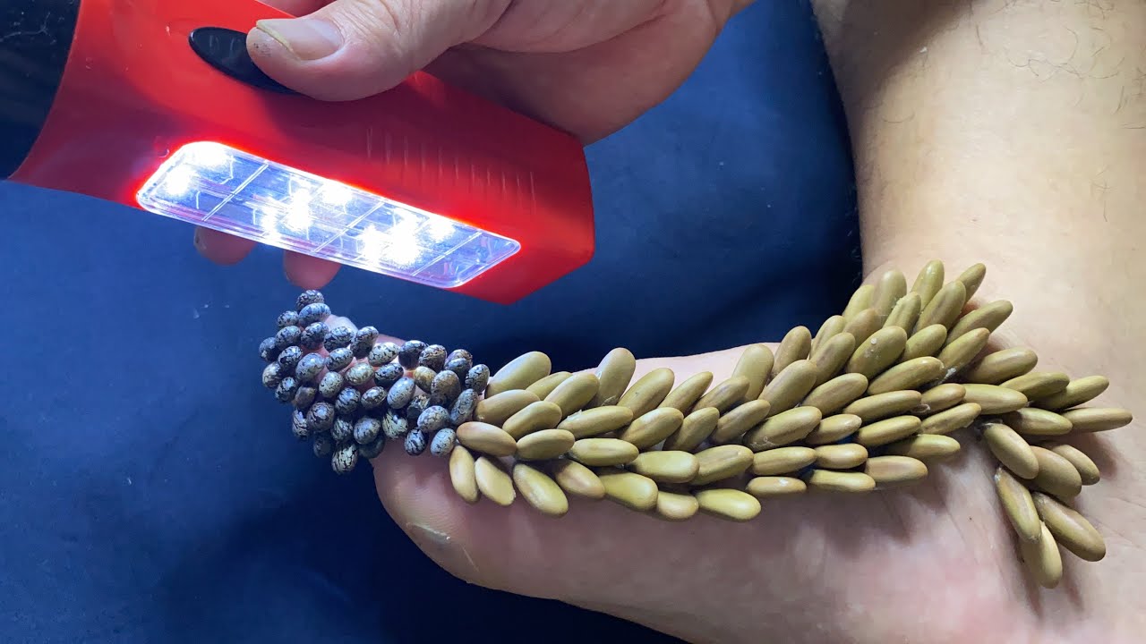 View of Use a flashlight to effectively remove ticks - YouTube