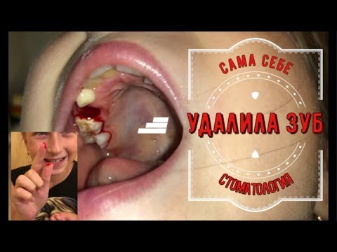 Сама себе удалила зуб. Много крови / Лиза Упс 1#11