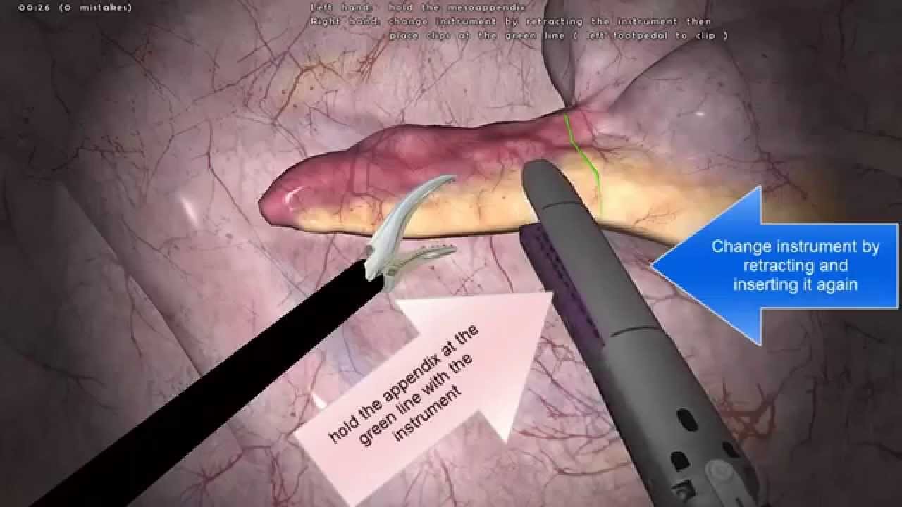 腹腔鏡手術訓練教學 Lap X 闌尾手術 Youtube 腹腔鏡手術訓練教學 Lap X 闌尾手術 Youtube