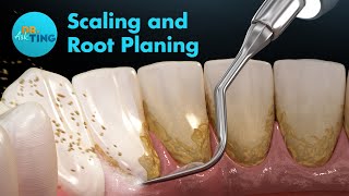 Scaling and Root Planing (SRP) | Ask Dr. Ting